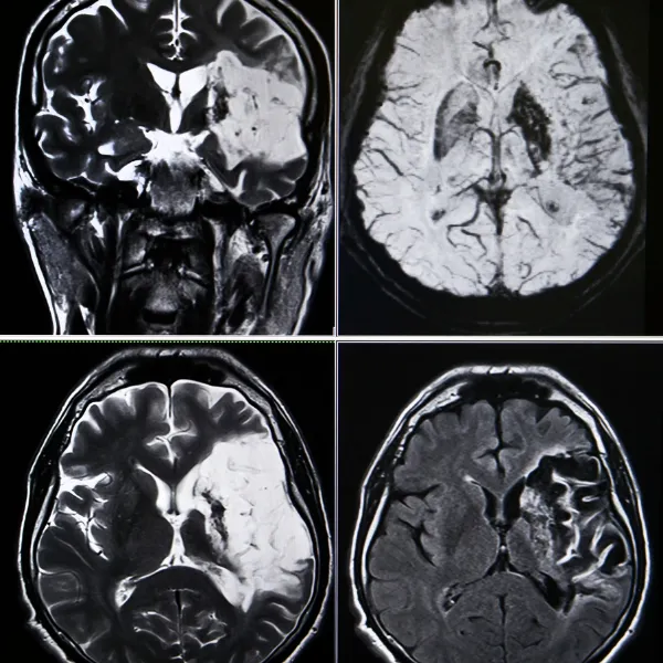 What Happens During a Stroke